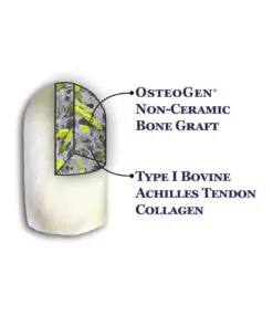 OsteoGen Plug - Bone Grafting Plug