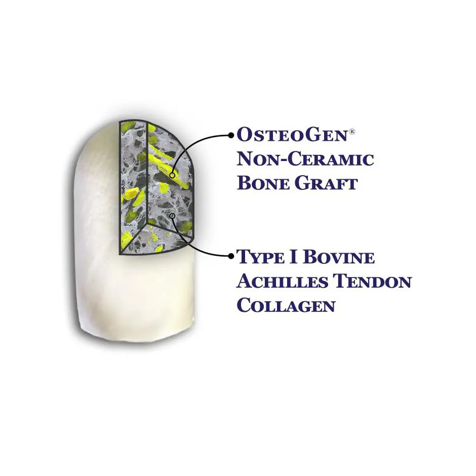 OsteoGen Plug - Bone Grafting Plug