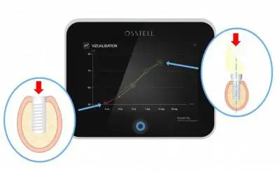 Osstell IDx