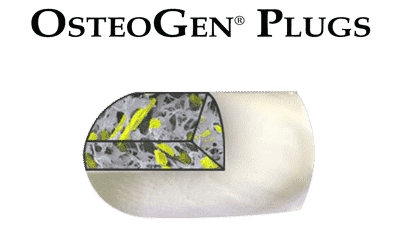OsteoGen Plug - Bone Grafting Plug