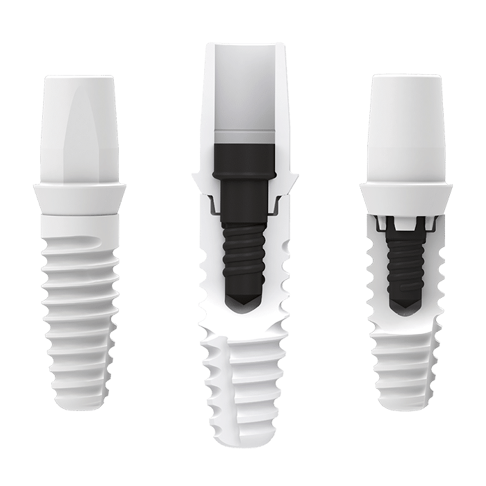 ZERAMEX® XT Tapered Ceramic Implant placed in Narrow Ridge - Emerginnova