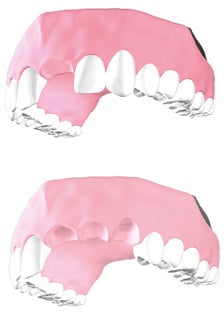 Zeramex P6 Prosthetic