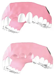 Zeramex P6 Prosthetic