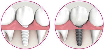 Restoration with Zeramex