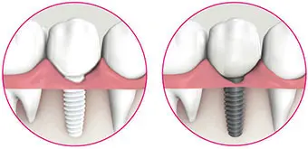 Restoration with Zeramex