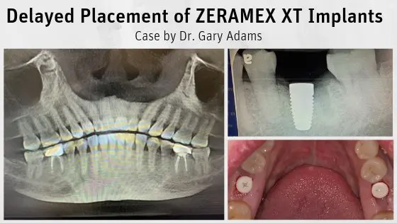 Delayed Placement of ZERAMEX XT Implants by Dr. Gary Adams