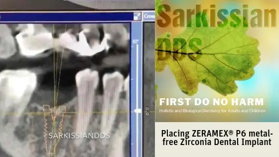 Dr. Joseph Sarkissian ZERAMEX P6 Case
