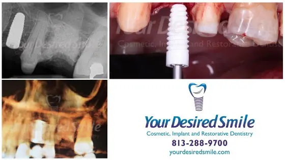 Guided Placement of ZERAMEX XT by Dr. Luis Alicea of Your Desired Smile