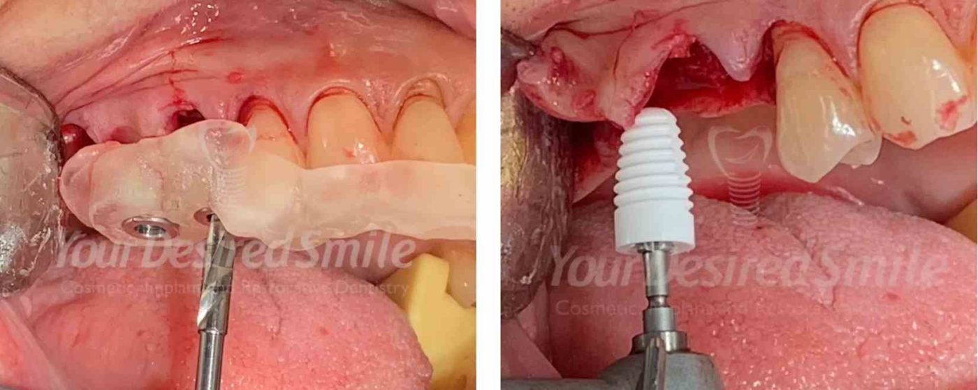 Posterior Zirconia Implants Guided Surgery Fig 4
