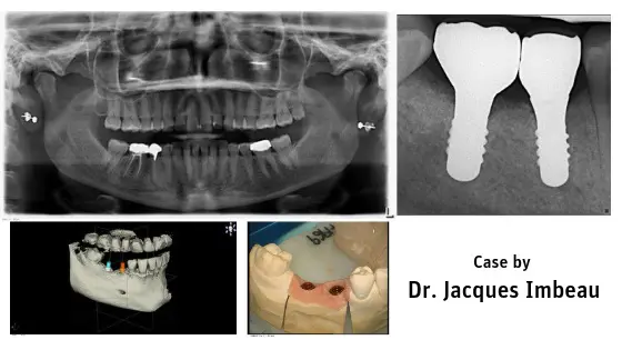 ZERAMEX® P6 Implant Placement