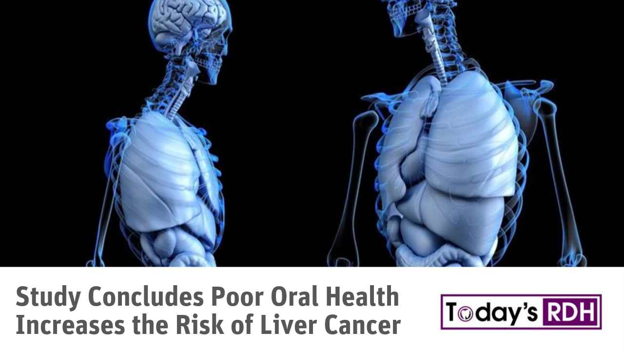 Study Concludes Poor Oral Health Increases the Risk of Liver Cancer