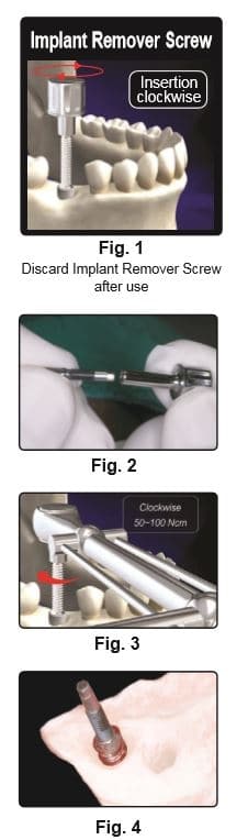 Implant Remover Kit Gen2