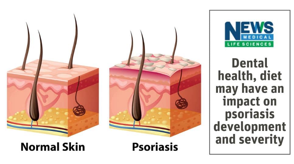 Dental health and psoriasis development