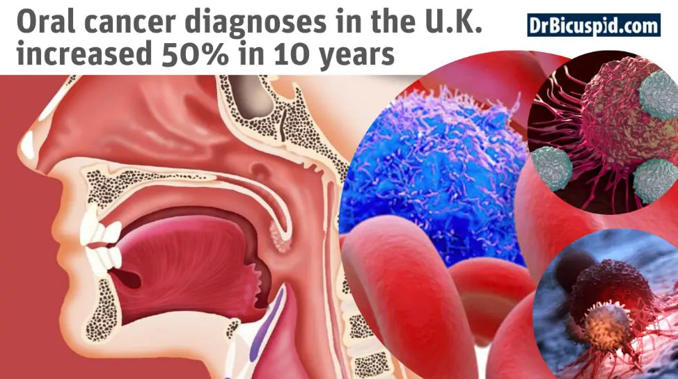 Oral Cancer in the UK