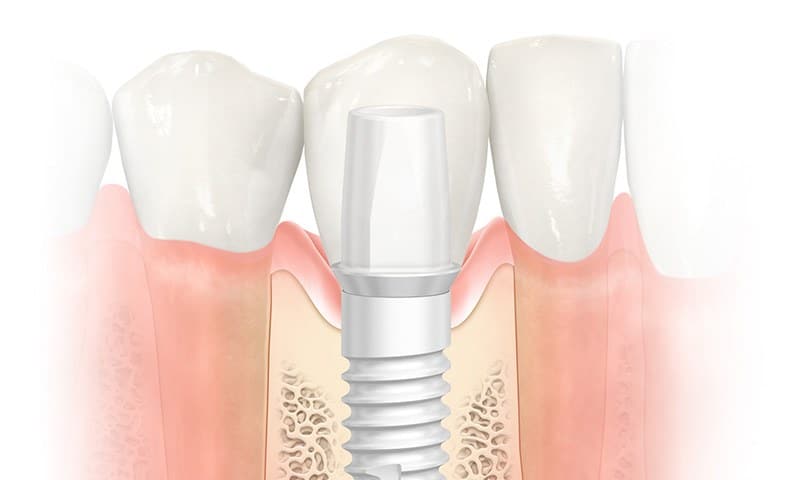 Zirconia Implants