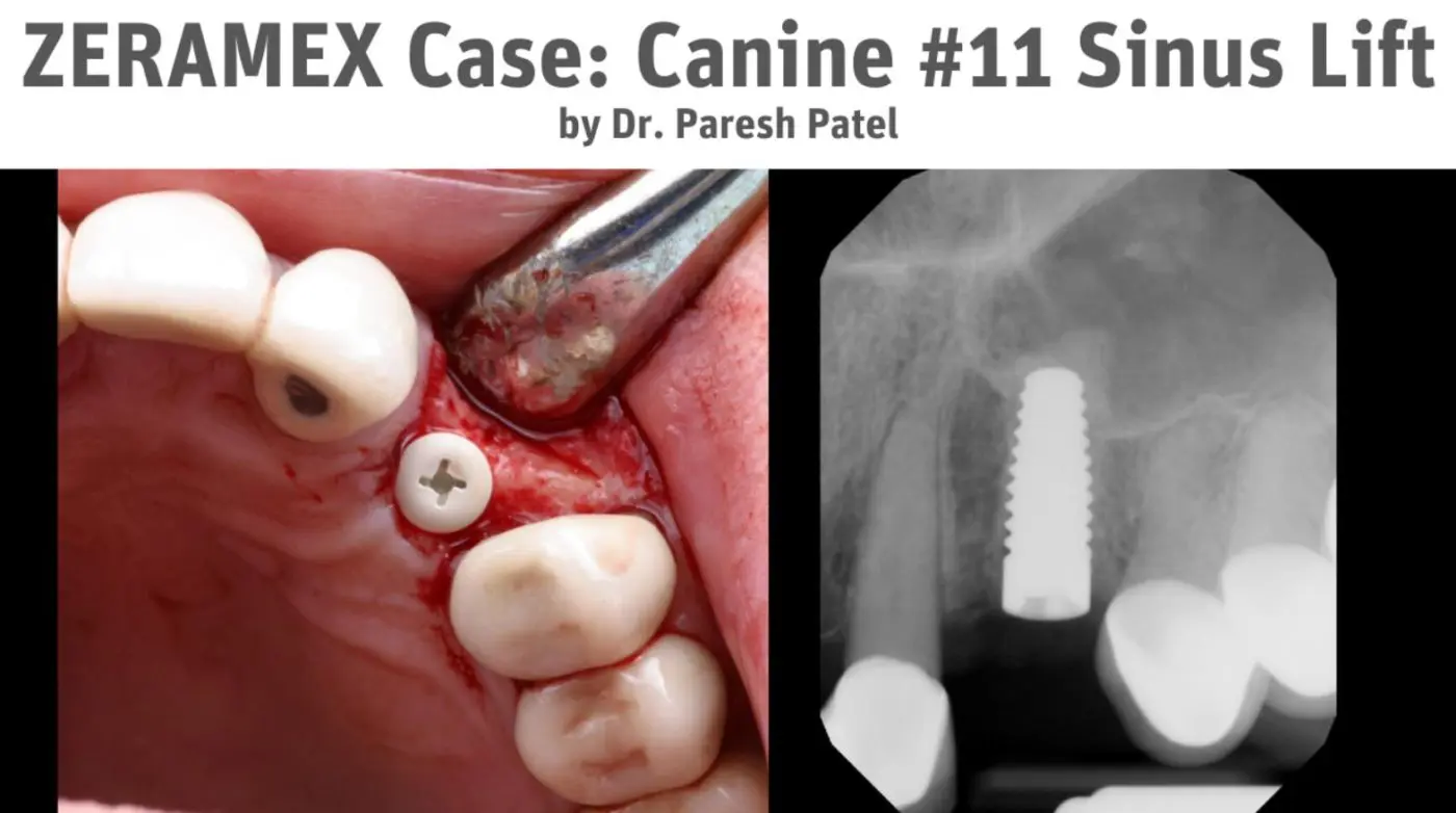 Dr. Paresh Patel First ZERAMEX Test Case