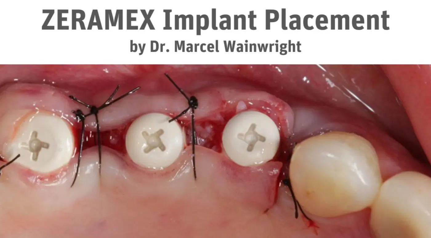 Marcel Wainwright Implant Case 1