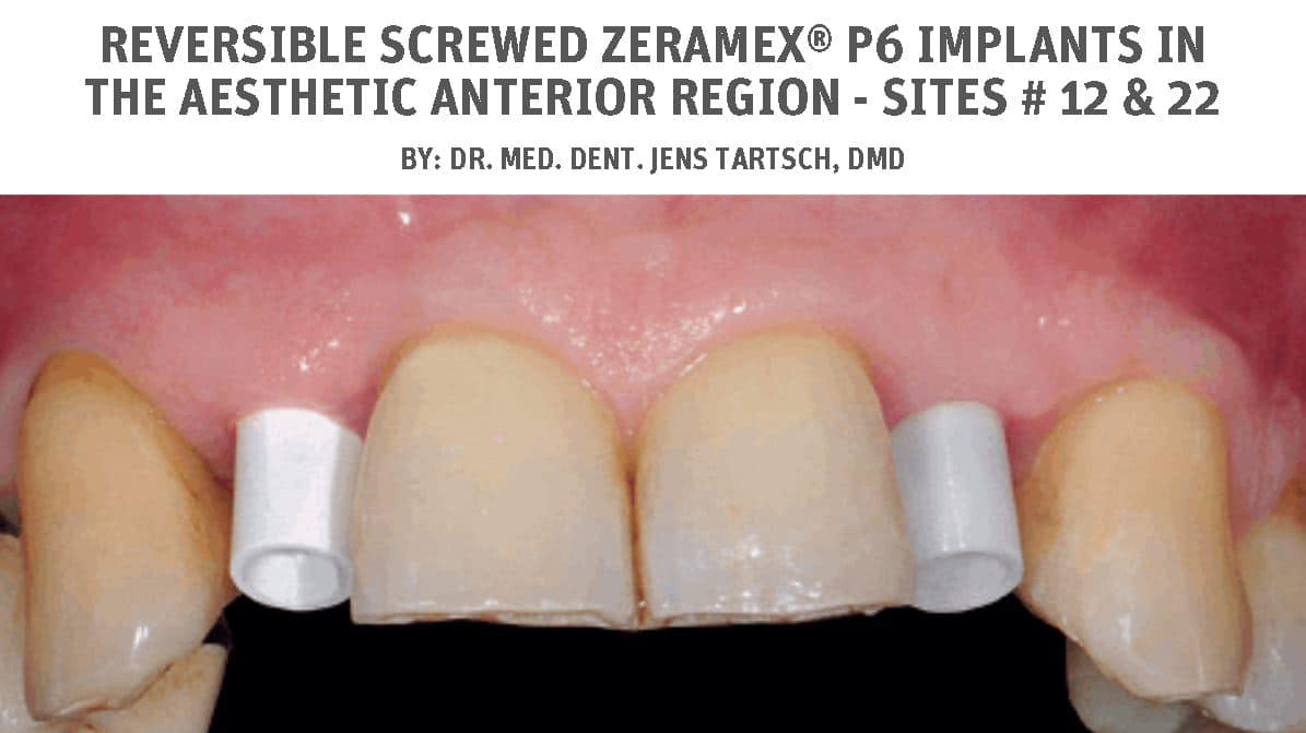 Reversible screwed ZERAMEX® P6 implants in the aesthetic anterior region