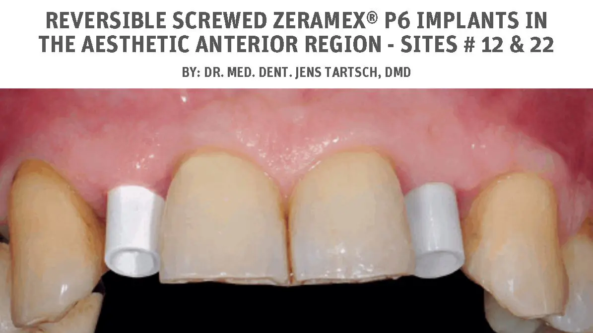 Reversible screwed ZERAMEX® P6 implants in the aesthetic anterior region