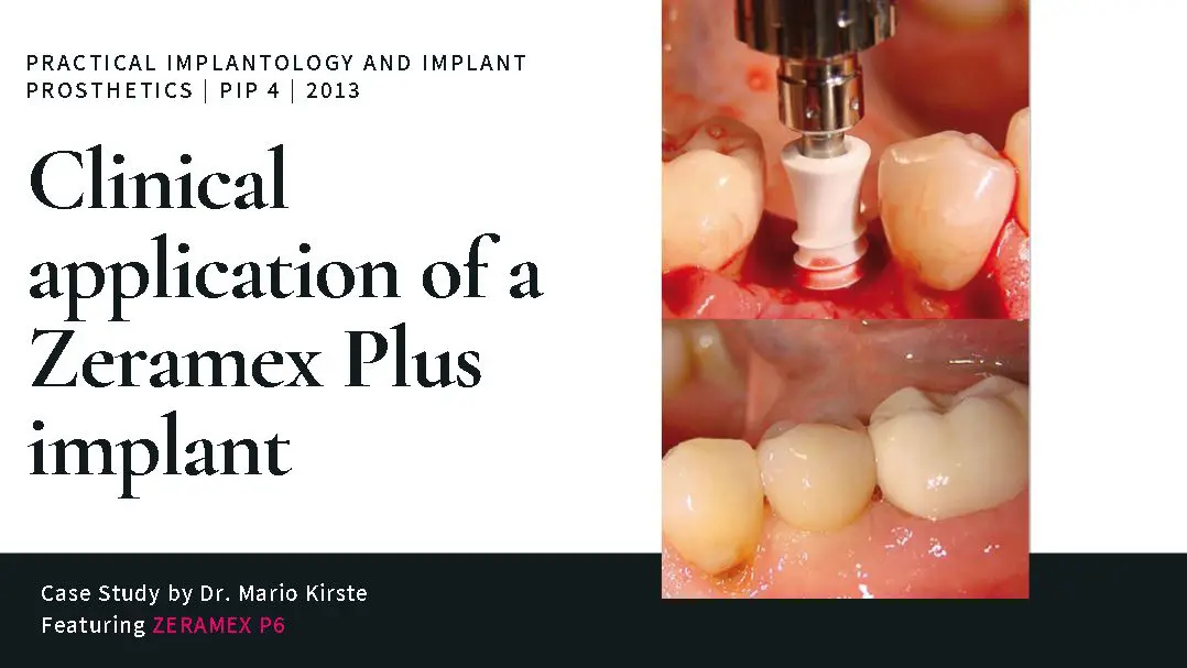 CLINICAL APPLICATION OF A ZERAMEX PLUS IMPLANT Banner
