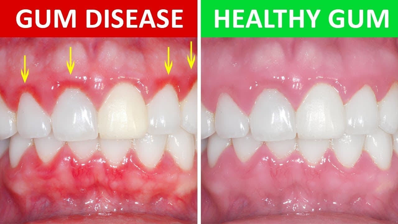 Gum disease