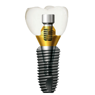 Dentium Implant