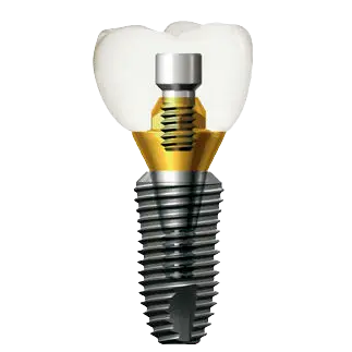 Dentium Implant
