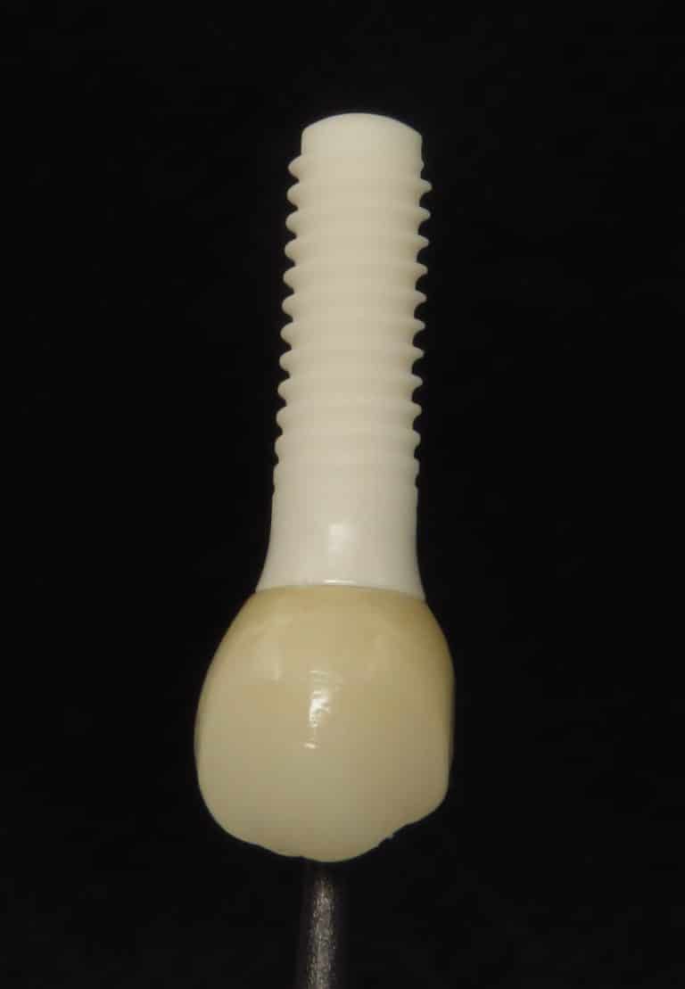 Ceramic Dental Implants Where Aesthetics Matter Emerginnova